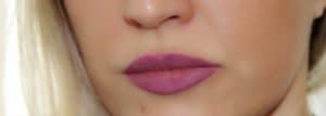 Lips after augmentation